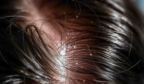 روغن رزماری برای درمان شوره سر، راه‌حلی طبیعی و مؤثر